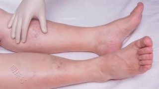 百家号:新澳资料免费精准-水肿是什么原因造成的