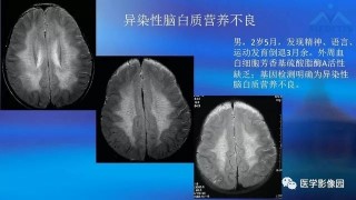 网易:澳门平特一肖100%免费-脑白质病变是什么意思