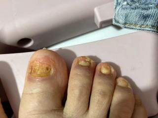 搜狐:新澳2024年精准一肖一码-灰指甲用什么药最有效