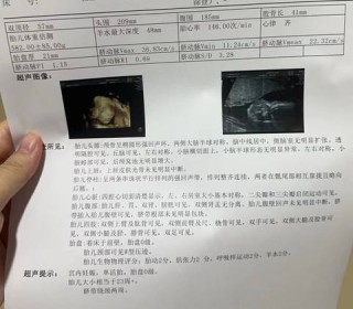 搜狐:澳门2024正版资料王中王-羊水少了对宝宝有什么影响