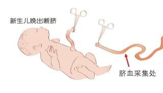 微博订阅:2004新澳精准资料免费提供-导管留婴儿血管5年
