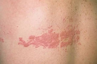 搜狐订阅：新奥资料免费精准-蔡国庆急性带状疱疹