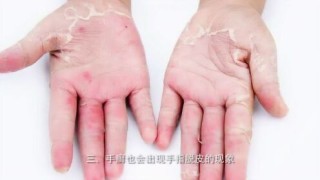 知乎：2024年澳门今晚开码料-手脱皮是缺什么维生素