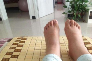 百家号:澳门最精准正最精准龙门客栈-水肿是什么样子