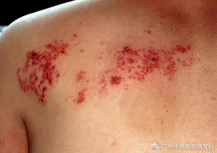 搜狐订阅：新奥资料免费精准-蔡国庆急性带状疱疹  第1张