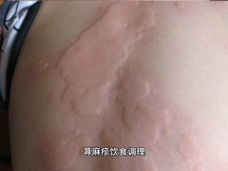 知乎：新奥资料免费精准-荨麻疹忌口什么食物  第1张