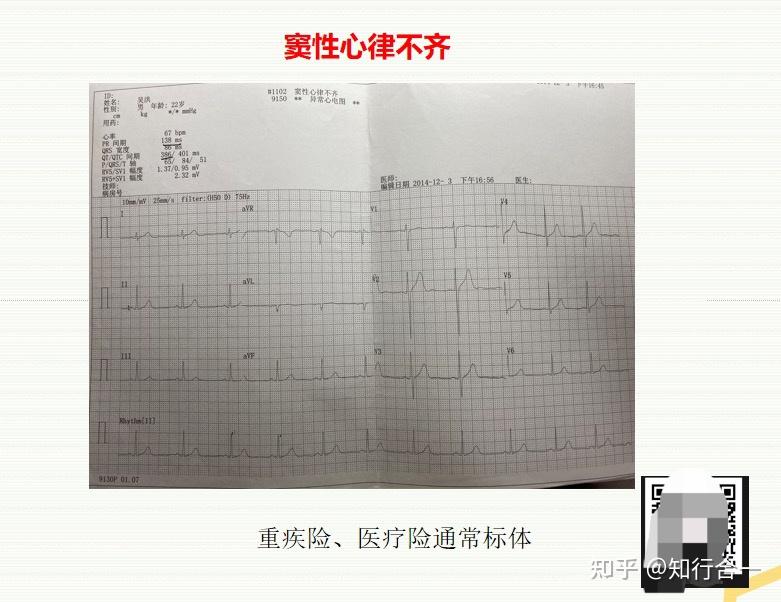 微博:最准一肖一码一一子中特-窦性心律不齐什么意思  第2张